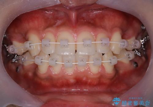 ワイヤー矯正中のクリーニング pmtcの治療後