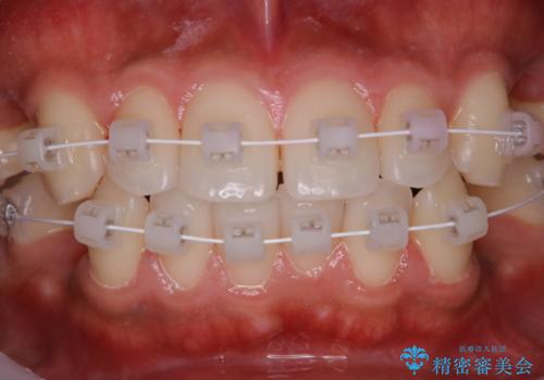 ワイヤー矯正中のクリーニング pmtcの治療後