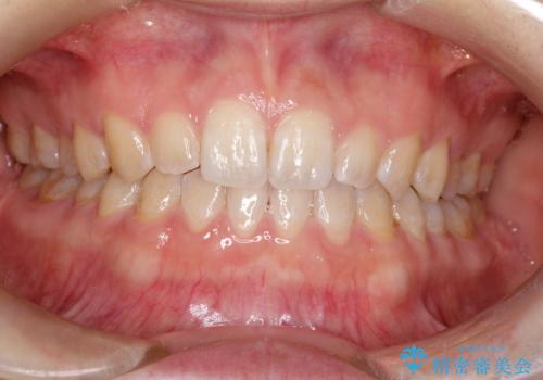 前歯の隙間を閉じたい　インビザラインによる矯正の症例 治療後