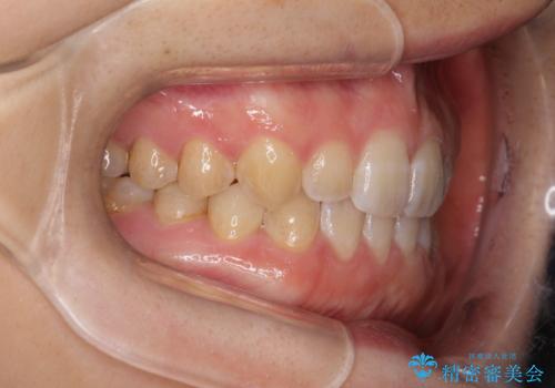 前歯の隙間を閉じたい インビザラインによる矯正の治療後