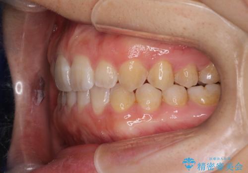 前歯の隙間を閉じたい インビザラインによる矯正の治療後