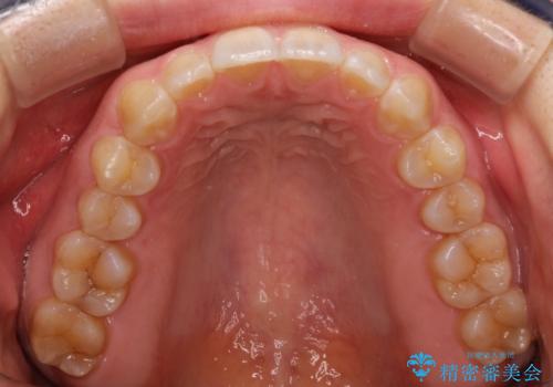 前歯の隙間を閉じたい インビザラインによる矯正の治療後