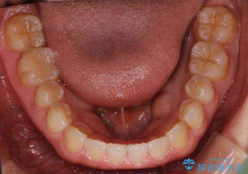 前歯の隙間を閉じたい インビザラインによる矯正の治療後