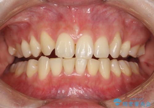 できるだけ白くしたい!エクセレントホワイトニングの症例 治療前