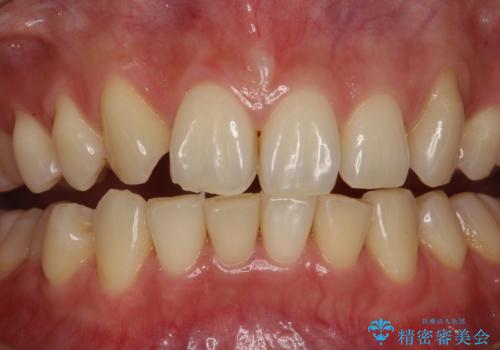 できるだけ白くしたい!エクセレントホワイトニングの治療前