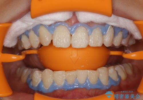 できるだけ白くしたい!エクセレントホワイトニングの治療中