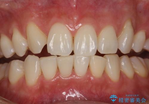 できるだけ白くしたい!エクセレントホワイトニングの治療後