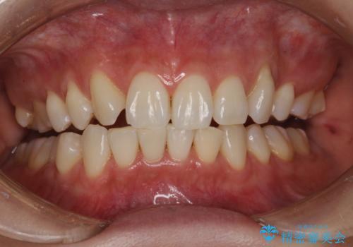 できるだけ白くしたい!エクセレントホワイトニングの症例 治療後