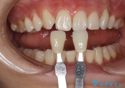 できるだけ白くしたい!エクセレントホワイトニングの治療後