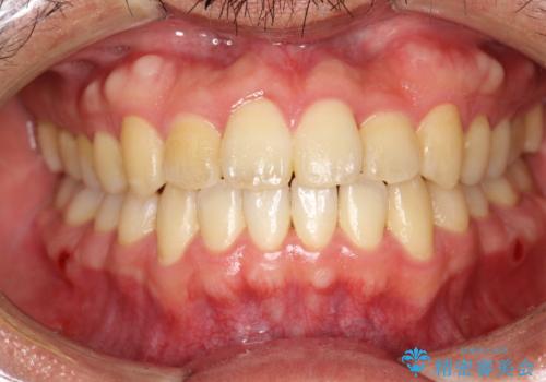 前歯が反対にかんでいる　インビザラインとワイヤーを組み合わせた矯正治療の治療後