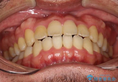 前歯が反対にかんでいる インビザラインとワイヤーを組み合わせた矯正治療の治療後