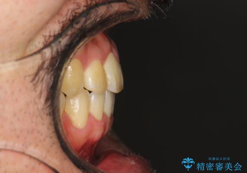 前歯が反対にかんでいる インビザラインとワイヤーを組み合わせた矯正治療の治療後