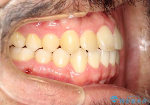 前歯が反対にかんでいる　インビザラインとワイヤーを組み合わせた矯正治療の治療後
