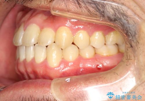 前歯が反対にかんでいる インビザラインとワイヤーを組み合わせた矯正治療の治療後