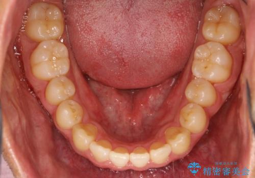 前歯が反対にかんでいる インビザラインとワイヤーを組み合わせた矯正治療の治療後