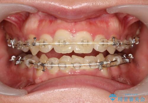 ワイヤー装置除去後のクリーニングの治療前