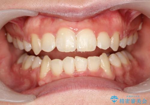 ワイヤー装置除去後のクリーニングの治療中