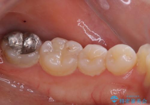 1年ぶりの歯科医院でクリーニングの治療前