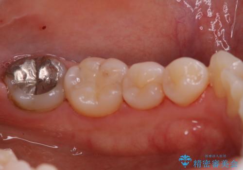 1年ぶりの歯科医院でクリーニングの治療後