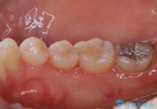 1年ぶりの歯科医院でクリーニングの症例 治療後