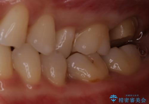 虫歯をセラミックで治療の治療中