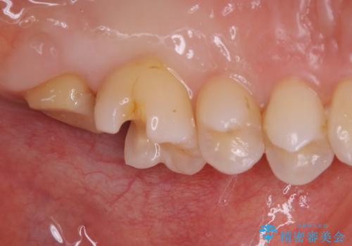 虫歯をセラミックで治療の治療中