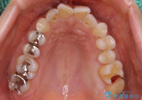 虫歯をセラミックで治療の治療中