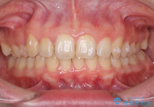 気になる八重歯を治したい インビザラインと補助装置を用いた抜歯治療の治療中