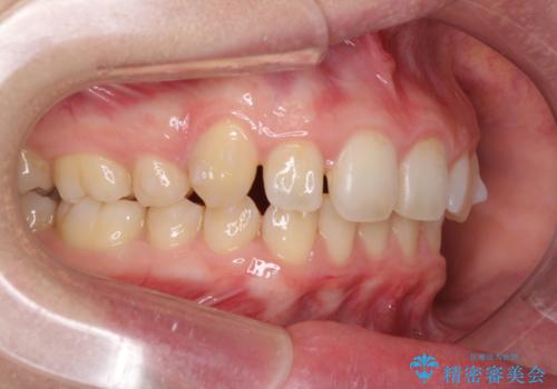 気になる八重歯を治したい　インビザラインと補助装置を用いた抜歯治療の治療中