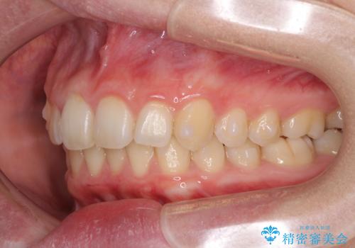 気になる八重歯を治したい インビザラインと補助装置を用いた抜歯治療の治療中