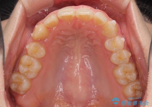 気になる八重歯を治したい インビザラインと補助装置を用いた抜歯治療の治療中