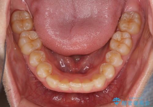 気になる八重歯を治したい インビザラインと補助装置を用いた抜歯治療の治療中
