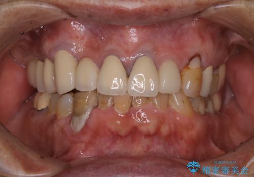 半年ぶりのクリーニング PMTC