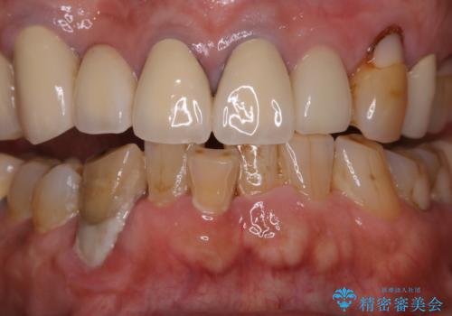 半年ぶりのクリーニング PMTCの治療前