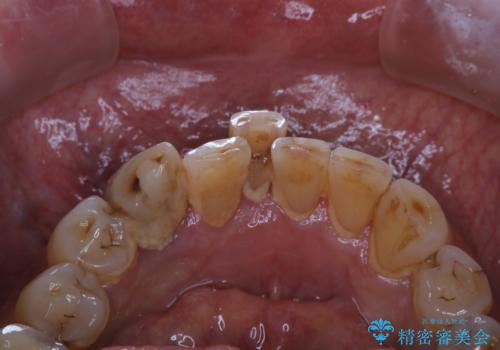 半年ぶりのクリーニング PMTCの治療前