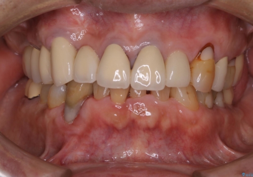 半年ぶりのクリーニング PMTCの症例 治療後