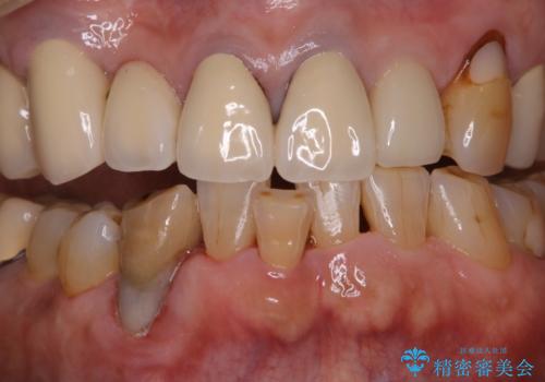 半年ぶりのクリーニング PMTCの治療後