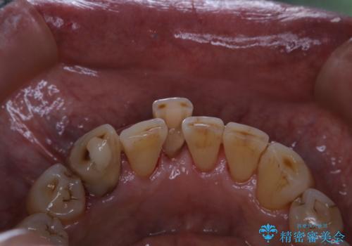 半年ぶりのクリーニング PMTCの治療後