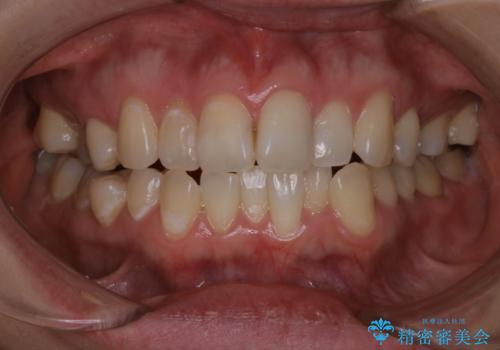 初めてのホワイトニング スペシャル3回照射の治療前