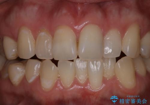 初めてのホワイトニング スペシャル3回照射の治療前