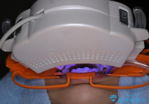 初めてのホワイトニング スペシャル3回照射の治療中