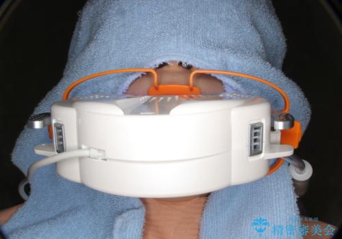 できるだけ白くしたい!エクセレントホワイトニングの治療中