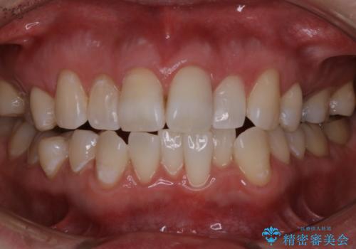 初めてのホワイトニング スペシャル3回照射の治療後
