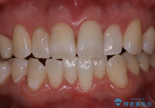 初めてのホワイトニング スペシャル3回照射の治療後