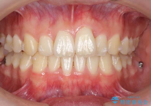 前歯のがたつき・すれちがい咬合を非抜歯で。流行の、格安マウスピースでは難しい、ワンランク上の治療の治療中