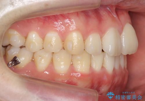 前歯のがたつき・すれちがい咬合を非抜歯で。流行の、格安マウスピースでは難しい、ワンランク上の治療の治療中