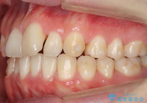 前歯のがたつき・すれちがい咬合を非抜歯で。流行の、格安マウスピースでは難しい、ワンランク上の治療の治療中