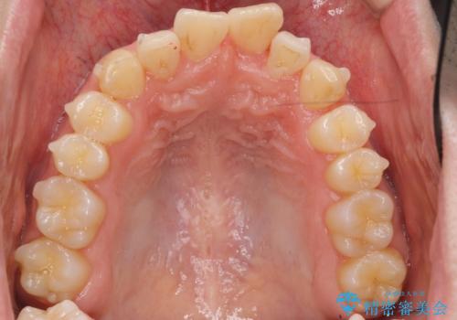 前歯のがたつき・すれちがい咬合を非抜歯で。流行の、格安マウスピースでは難しい、ワンランク上の治療の治療中