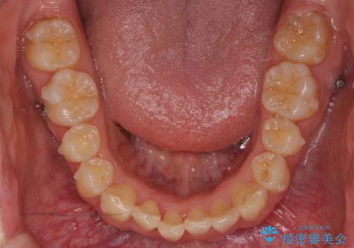 前歯のがたつき・すれちがい咬合を非抜歯で。流行の、格安マウスピースでは難しい、ワンランク上の治療の治療中
