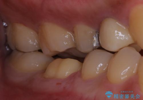 銀歯をセラミックにの治療中